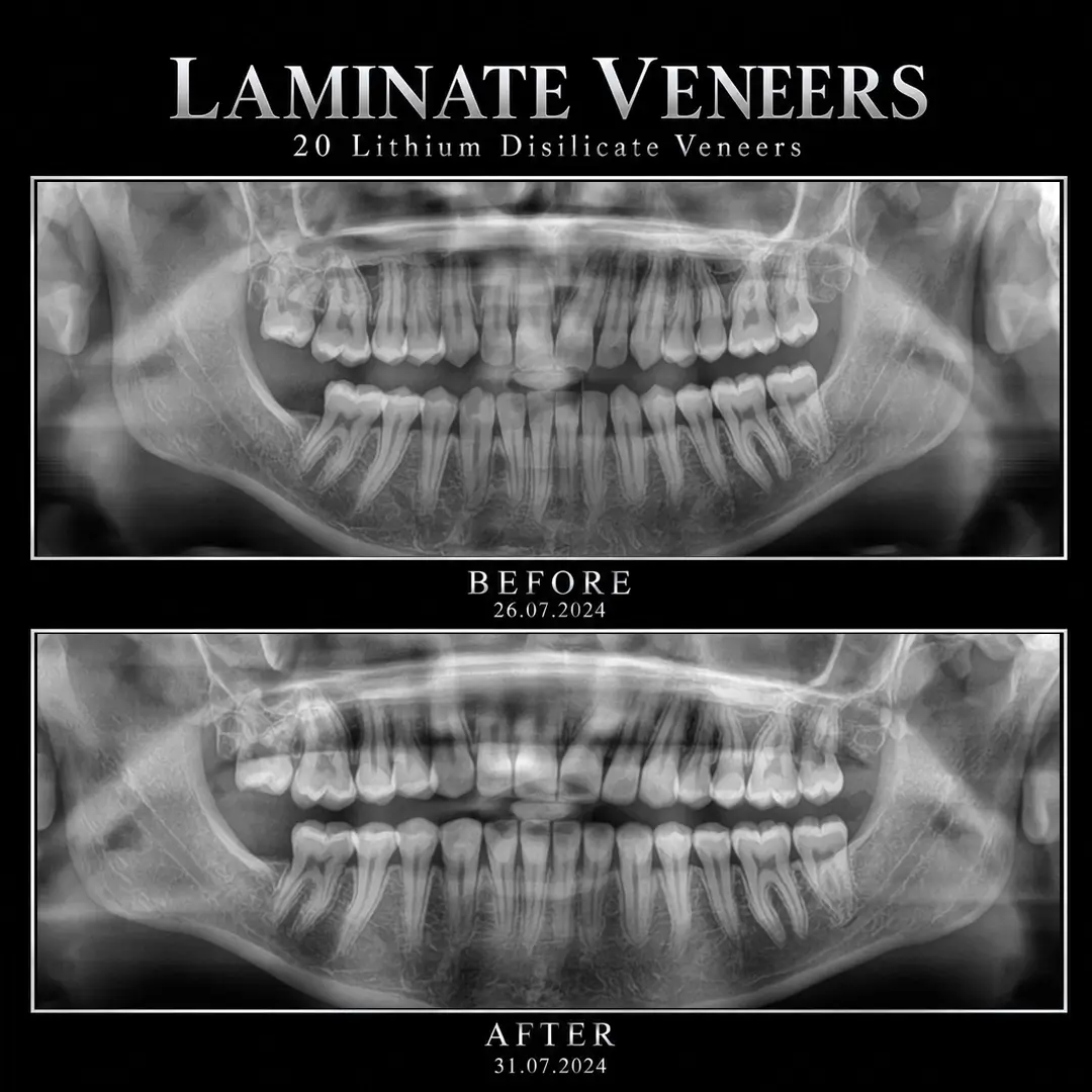 Why Preparation and Cementation Sat Four Days Apart