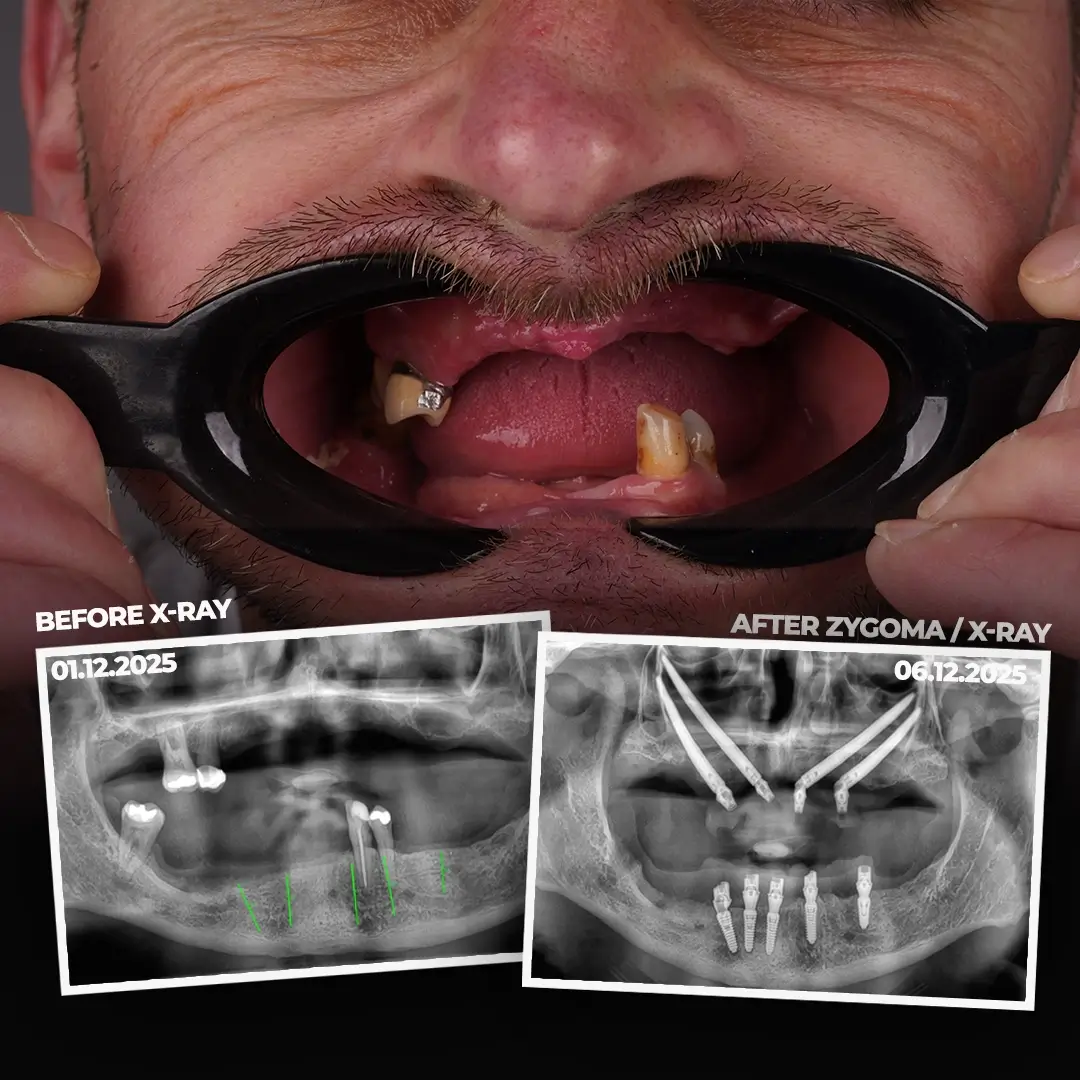 Why Two Arches at Once Is the Harder Case